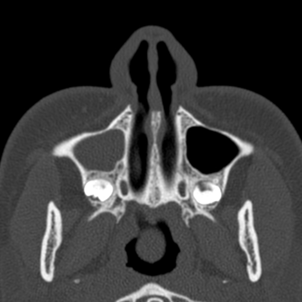 Antrochoanal polyp (Radiopaedia 33984-35202 Axial bone window 11).jpg