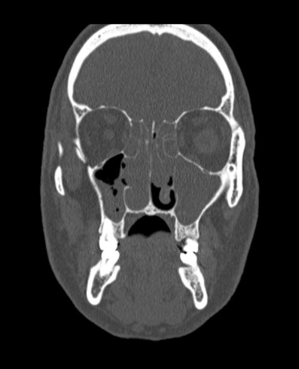 Antrochoanal polyp (Radiopaedia 79011-92169 Coronal bone window 50).jpg