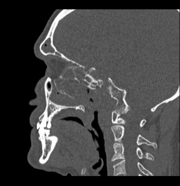 Antrochoanal polyp (Radiopaedia 79011-92169 Sagittal bone window 16).jpg
