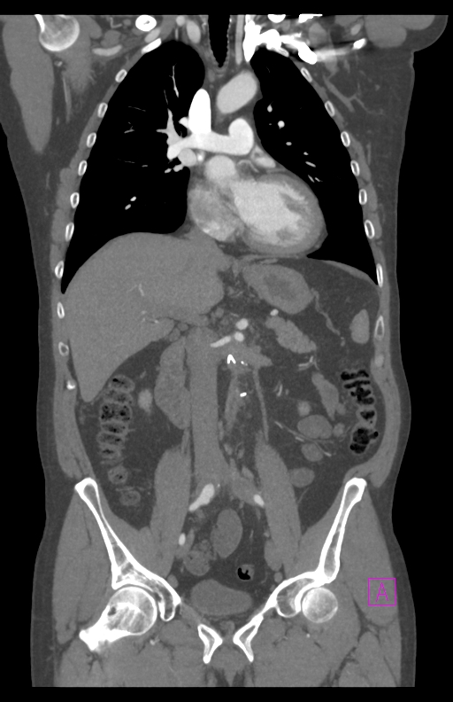 Aortectomy and axillary-bifemoral bypass (Radiopaedia 28303-28545 C 45).jpg