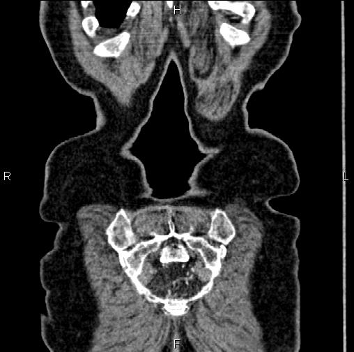 Aortic aneurysm and Lemmel syndrome (Radiopaedia 86499-102554 C 65).jpg