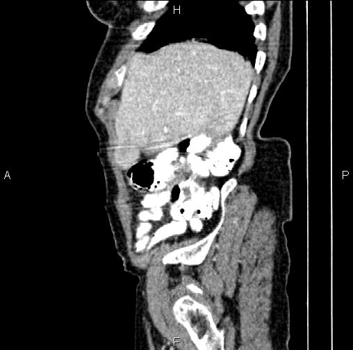 File:Aortic aneurysm and Lemmel syndrome (Radiopaedia 86499-102554 D 12).jpg