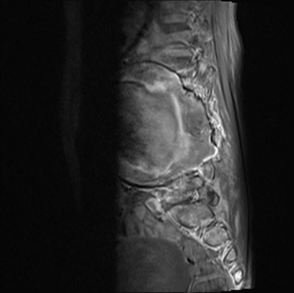 File:Aortic aneurysm with spinal destruction (Radiopaedia 42301-45409 Sagittal T1 fat sat 19).jpg