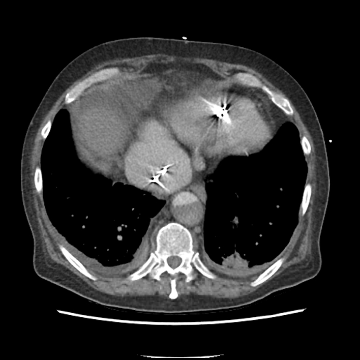 Aortic arch graft infection (FDG PET-CT) (Radiopaedia 71975-82437 A 49).jpg