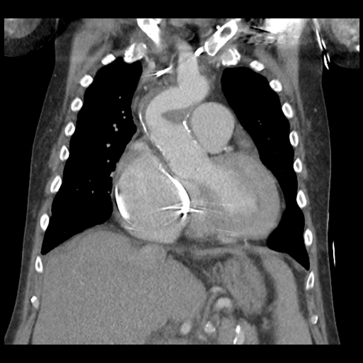 Aortic arch graft infection (FDG PET-CT) (Radiopaedia 71975-82437 Coronal 24).jpg