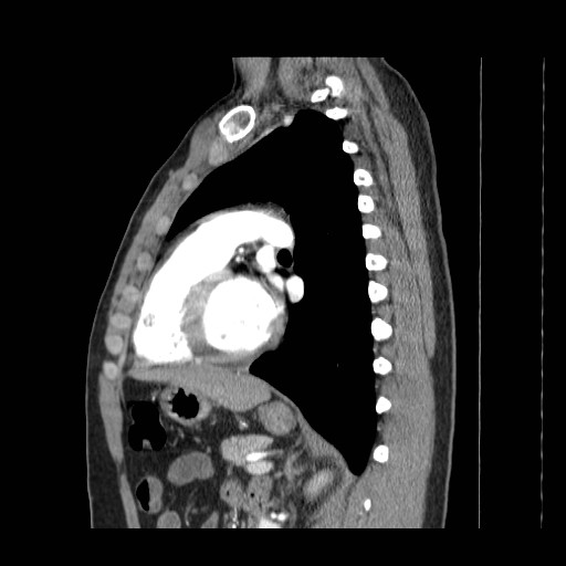 File:Aortic arch stent (Radiopaedia 30030-30595 E 18).jpg