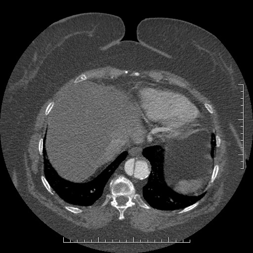 Aortic dissection- Stanford A (Radiopaedia 35729-37268 B 15).jpg