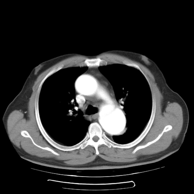 Aortic dissection (Radiopaedia 44411-48061 C 10).jpg