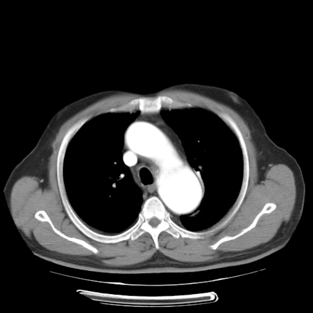 Aortic dissection (Radiopaedia 44411-48061 C 9).jpg