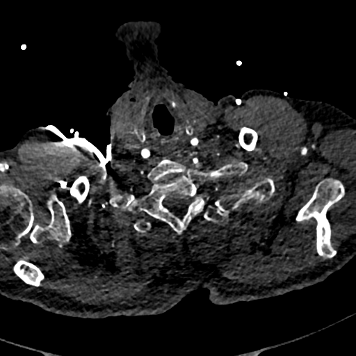 File:Aortic dissection - DeBakey type II (Radiopaedia 64302-73082 A 5).png