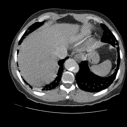 File:Aortic dissection - Stanford A -DeBakey I (Radiopaedia 28339-28587 B 85).jpg