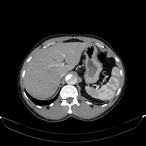 File:Aortic dissection - Stanford type A (Radiopaedia 83418-98500 A 61).jpg