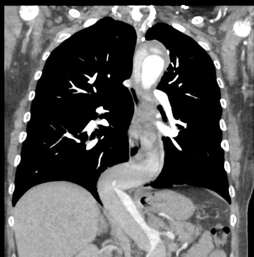 File:Aortic dissection - Stanford type B (Radiopaedia 50171-55512 B 49).png