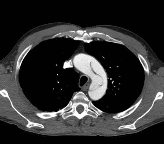 Aortic dissection - Stanford type B (Radiopaedia 73648-84437 A 20).jpg