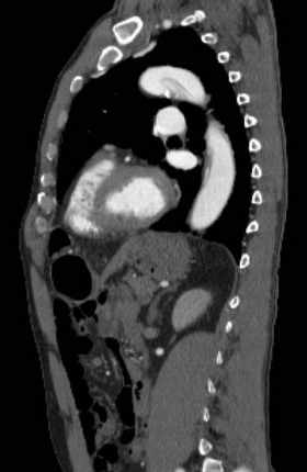 File:Aortic dissection - Stanford type B (Radiopaedia 73648-84437 C 57).jpg