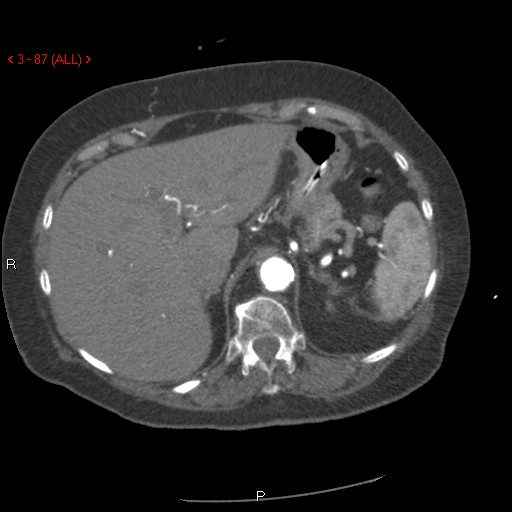 Aortic intramural hematoma (Radiopaedia 27746-28001 A 87).jpg
