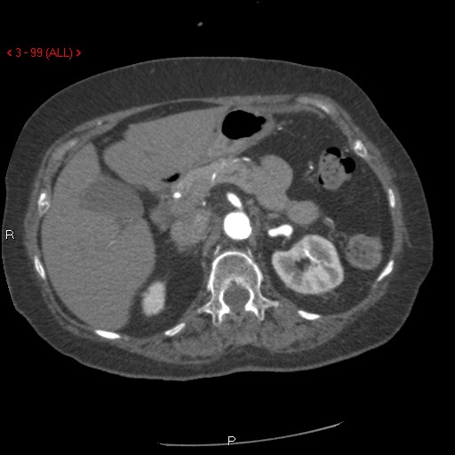 File:Aortic intramural hematoma (Radiopaedia 27746-28001 A 99).jpg