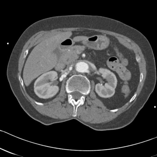 Aortic intramural hematoma from penetrating atherosclerotic ulcer (Radiopaedia 31137-31836 A 95).jpg