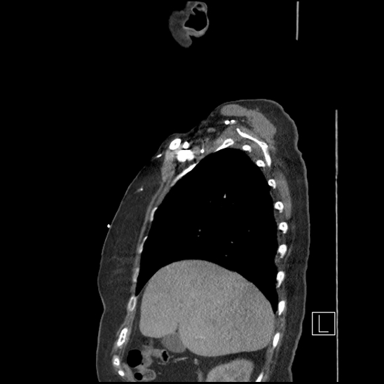File:Aortic intramural hematoma with dissection and intramural blood pool (Radiopaedia 77373-89491 D 17).jpg
