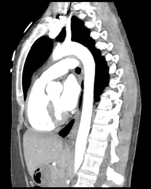 Aortic valve non-coronary cusp thrombus (Radiopaedia 55661-62189 D 26).png