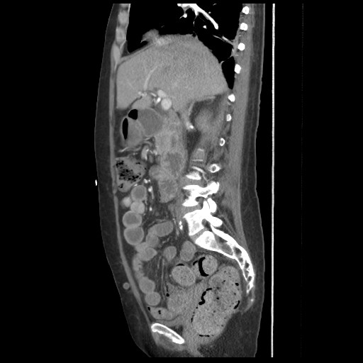 File:Aorto-duodenal fistula (Radiopaedia 25668-25850 C+ arterial phase 5).jpg