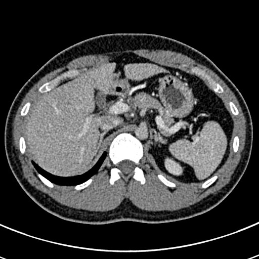 Apical lung mass mimic - neurogenic tumor (Radiopaedia 59918-67521 A 84).jpg