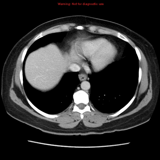 File:Appendiceal mucinous cystadenoma (Radiopaedia 8263-9111 Axial liver window 13).jpg