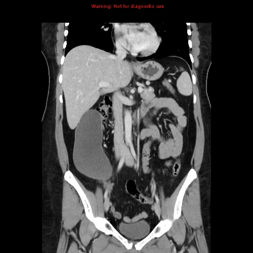 File:Appendiceal mucinous cystadenoma (Radiopaedia 8263-9111 B 36).jpg