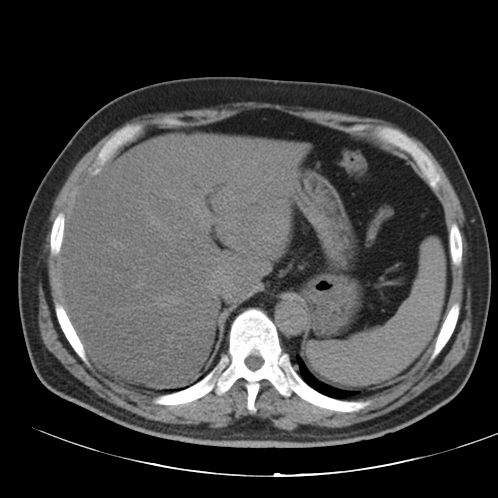 File:Appendicitis and giant appendicolith (Radiopaedia 80251-93588 Axial non-contrast 5).jpg