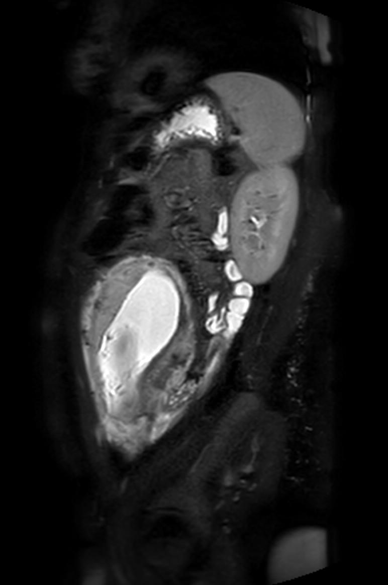 Appendicitis in gravida (MRI) (Radiopaedia 89433-106395 Sagittal T2 SPAIR 17).jpg