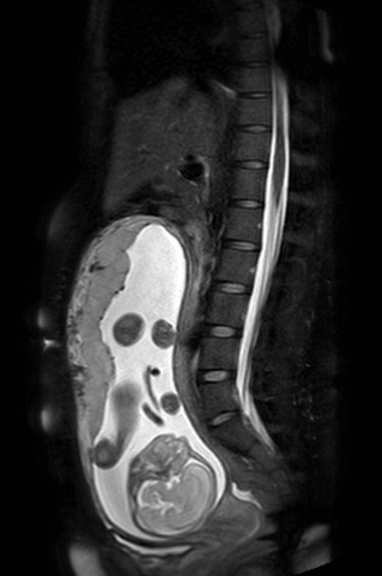 Appendicitis in gravida (MRI) (Radiopaedia 89433-106395 Sagittal T2 SPAIR 31).jpg