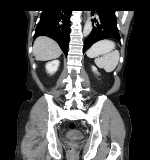 File:Appendicitis with localized perforation and abscess formation (Radiopaedia 49035-54130 B 36).jpg