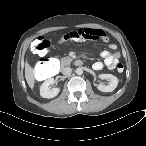 Appendicitis with thickening of the terminal ileum (Radiopaedia 42432-45550 A 40).png