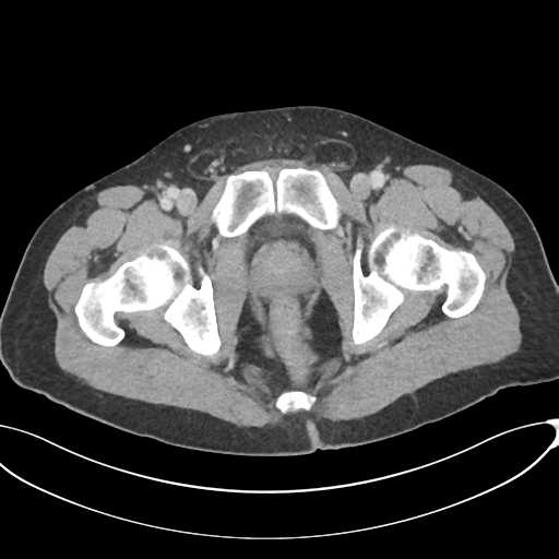 Appendicitis with thickening of the terminal ileum (Radiopaedia 42432-45550 A 95).png