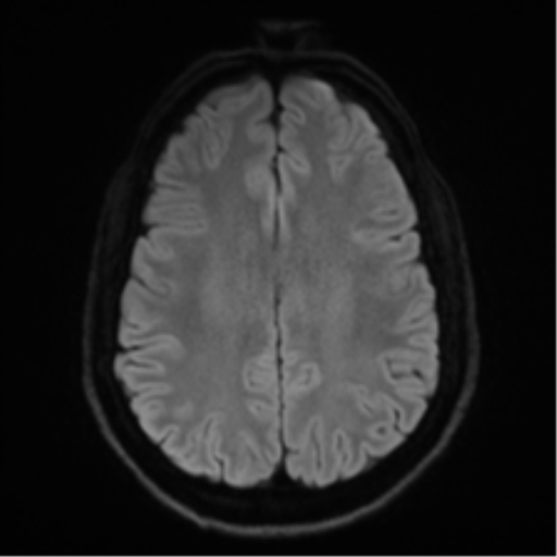 Arachnoid cyst - cerebellopontine angle (Radiopaedia 59689-67083 Axial DWI 60).png