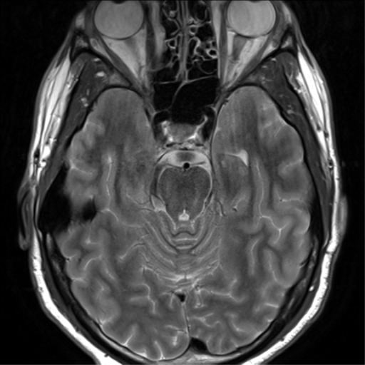 File:Arachnoid cyst - cerebellopontine angle (Radiopaedia 59689-67083 Axial T2 19).png