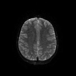 Arachnoid cyst - middle cranial fossa (Radiopaedia 67671-77088 Axial DWI 46).jpg