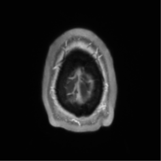 File:Arachnoid cyst with subdural hematoma (Radiopaedia 85892-101743 Axial T1 C+ 79).png