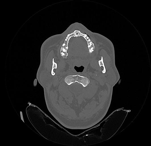 Arcuate foramen (Radiopaedia 89833-106944 Axial bone window 47).jpg