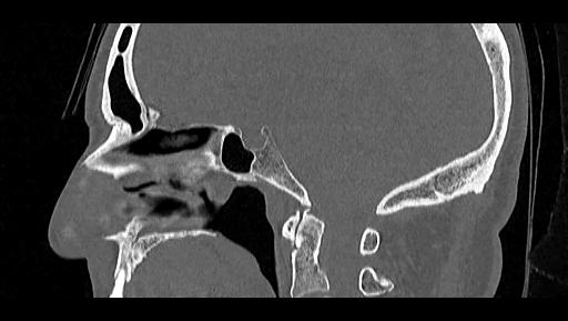 Arcuate foramen (Radiopaedia 89833-106944 Sagittal bone window 54).jpg