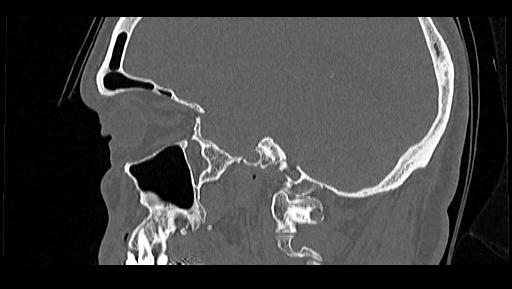 Arcuate foramen (Radiopaedia 89833-106944 Sagittal bone window 98).jpg
