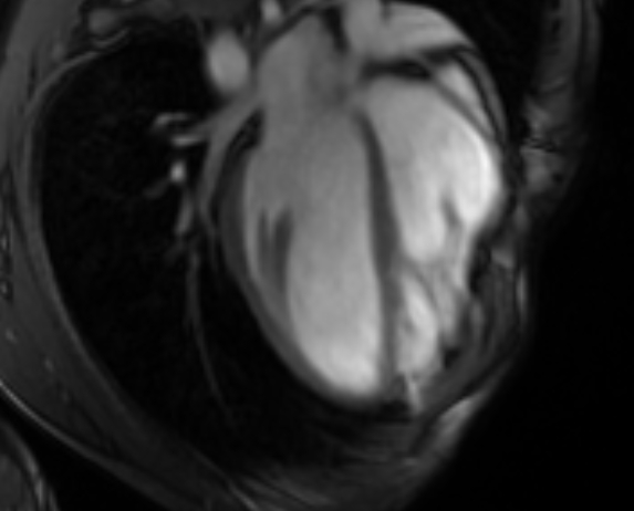 File:Arrhythmogenic right ventricular cardiomyopathy (Radiopaedia 69564-79464 4ch cine 60).jpg
