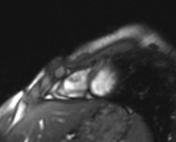 Arrhythmogenic right ventricular cardiomyopathy (Radiopaedia 69564-79464 short axis cine 31).jpg