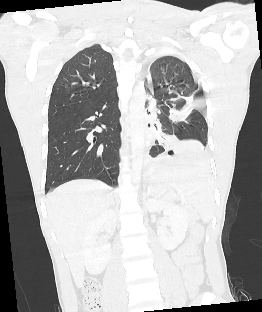 Arrow injury to the chest (Radiopaedia 85367-100975 Coronal lung window 89).jpg