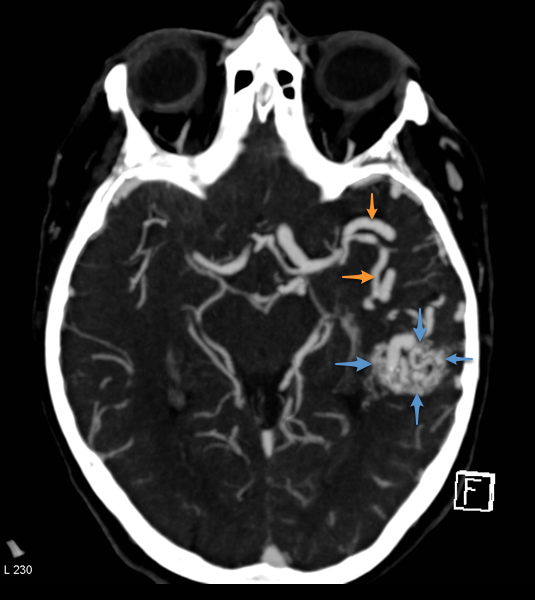 File:Arteriovenous malformation - cerebral (Radiopaedia 8172-14683 Figure 1 1).png