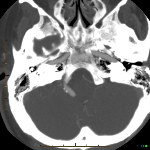 File:Artifactual basilar artery stenosis due to metallic stent (Radiopaedia 31206-31923 A 9).jpg
