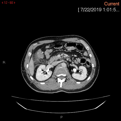 File:Ascending colonic diverticulum mimicking acute appendicitis (Radiopaedia 69943-80198 A 60).jpg