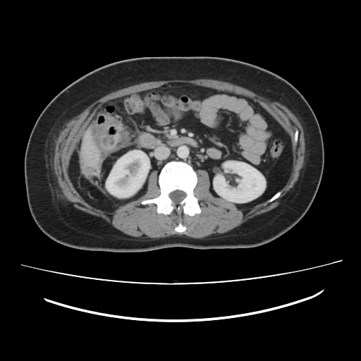 Ascending retrocecal appendicitis with liver abscesses (Radiopaedia 60066-67615 B 43).jpg