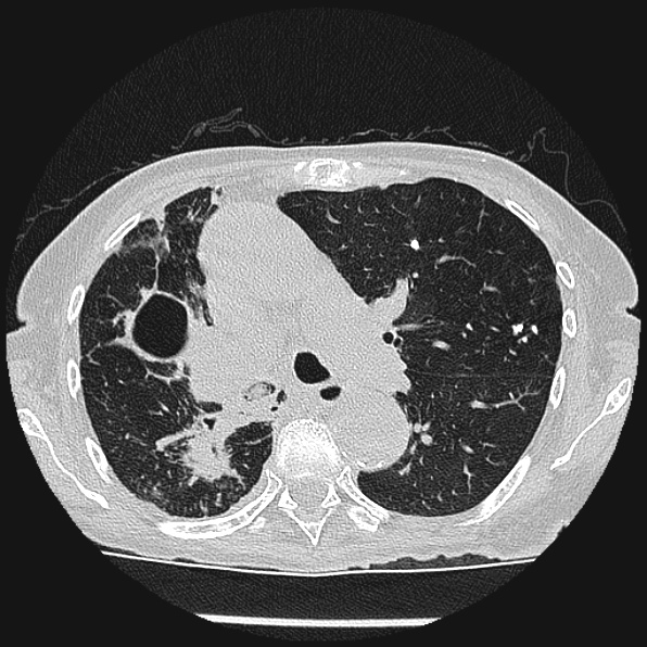 Aspergilloma (Radiopaedia 24458-24763 Axial lung window 27).jpg
