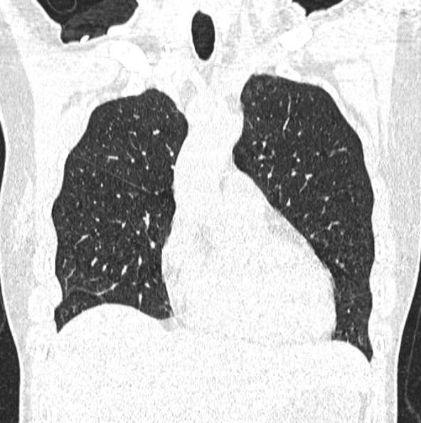 File:Aspergilloma (Radiopaedia 26223-26347 Coronal lung window 16).jpg